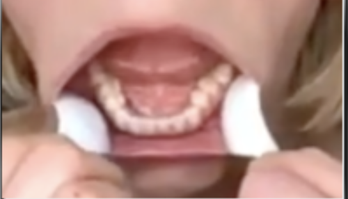 Bottom Teeth Sample