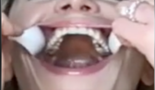 Top Teeth Sample